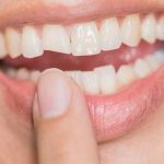 Có thể hàn răng bị mẻ được không?
