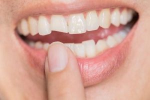 Read more about the article Có thể hàn răng bị mẻ được không?