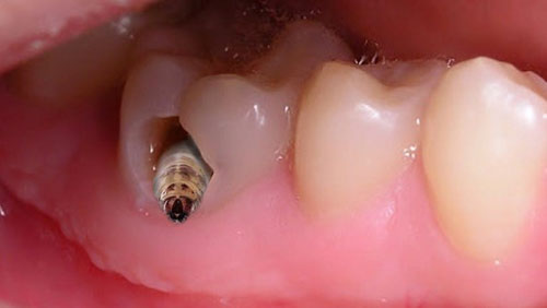 Con sâu răng có thật không?