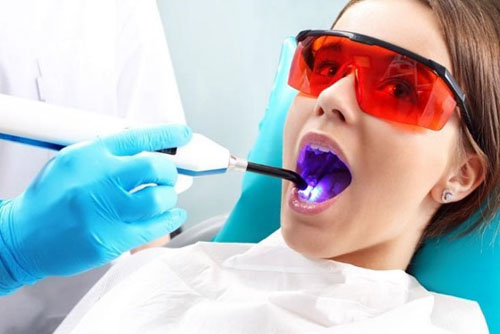 Công nghệ trám răng bằng Laser Tech là gì?
