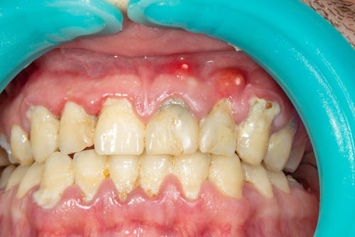 Đau nhức răng có thể do mắc các bệnh viêm nướu, viêm nha chu