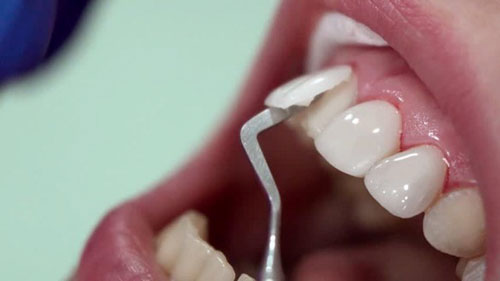 Đau nhức sau khi bọc răng sứ do men răng nhạy cảm