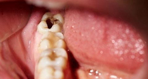 Điều trị chữa tủy trám răng người lớn phức tạp