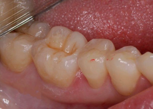 Trám răng có bền không? Bao lâu thì thay miếng trám - SORADENTAL