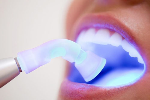 Dùng phản ứng quang trùng hợp đông cứng vết trám răng