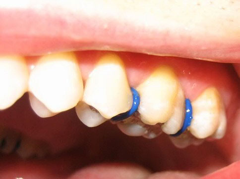 Giai đoạn đặt thun tách kẽ răng có thể gây đau nhức nhẹ