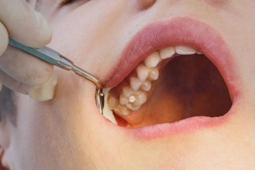 Hàn trám răng mang nhiều lợi ích