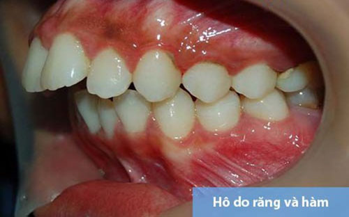 Hình ảnh hô do răng và hàm
