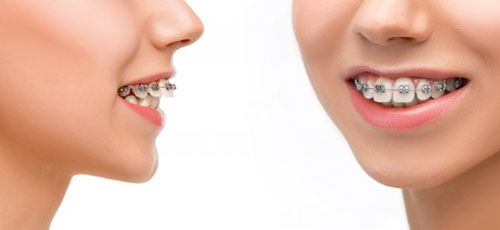 Hô do răng có thể điều trị bằng phương pháp niềng răng