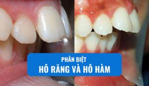 Read more about the article Hô hàm và hô răng có cách nhận biết như thế nào?