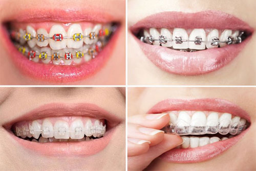 Lựa chọn phương pháp niềng răng phù hợp để đạt hiệu quả nhanh chóng