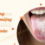 Lưỡi trắng gây hôi miệng nguyên nhân và cách điều trị?