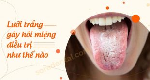 Lưỡi trắng gây hôi miệng điều trị như thế nào?