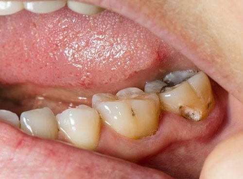 Mắc bệnh lý răng miệng chưa điều trị