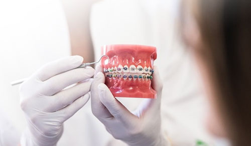 Mắc cài được thiết lế và chế tác riêng biệt cho từng tình trạng răng