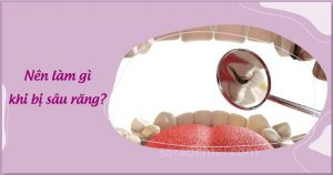 Read more about the article Nên làm gì khi bị sâu răng?