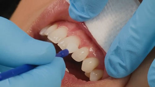 Ngăn ngừa sâu răng hiệu quả