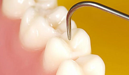 Nhiều yếu tố ảnh hưởng đến chi phí trám răng