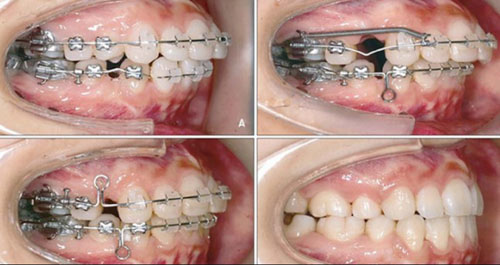 Nhổ răng khi niềng mục đích tạo khoảng trống cho các răng dịch chuyển tốt hơn