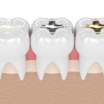 Những vật liệu trám răng được dùng phổ biến