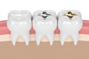 Read more about the article Những vật liệu trám răng được dùng phổ biến