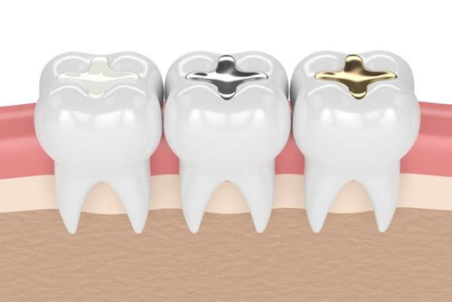 Những vật liệu trám răng được dùng phổ biến