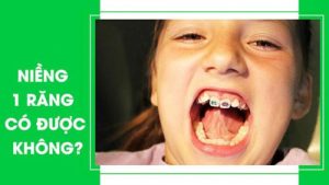 Read more about the article Niềng răng 1 cái bao nhiêu tiền? Và có được không?