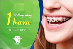 Read more about the article Niềng răng 1 hàm có được không? Chỉ định trường hợp nào?