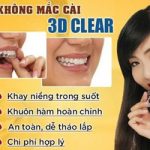 Niềng răng 3D Clear là gì? Giá bao nhiêu?