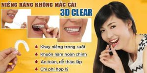 Read more about the article Niềng răng 3D Clear là gì? Giá bao nhiêu?