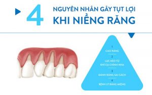 Read more about the article Niềng răng bị tụt lợi nguyên nhân và cách khắc phục hiệu quả