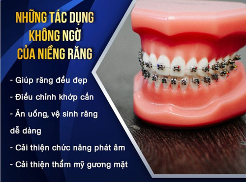Niềng răng đem lại nhiều lợi ích đáng kể