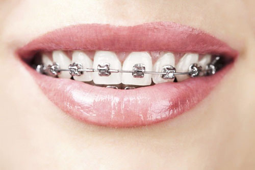 Niềng răng giúp điều chỉnh các răng mọc đều đặn