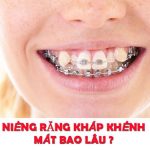 Niềng răng khấp khểnh mất bao lâu mới đạt hiệu quả?