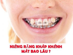 Read more about the article Niềng răng khấp khểnh mất bao lâu mới đạt hiệu quả?