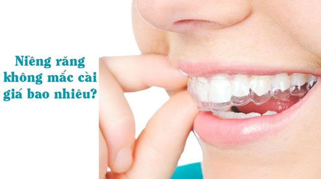 Read more about the article Niềng răng không mắc cài giá bao nhiêu? Thời gian bao lâu?