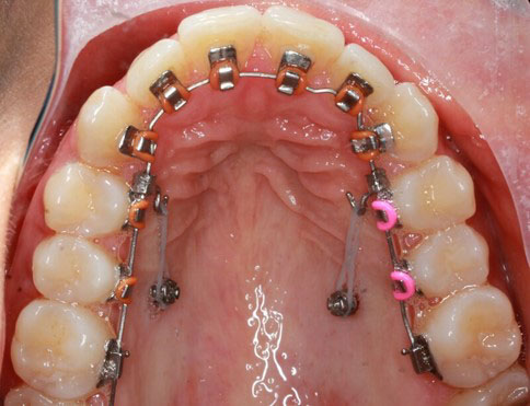 Niềng răng mắc cài mặt lưỡi với khí cụ được gắn ở mặt trong của răng