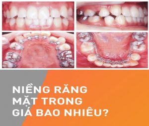 Read more about the article Niềng răng mắc cài mặt trong giá bao nhiêu?
