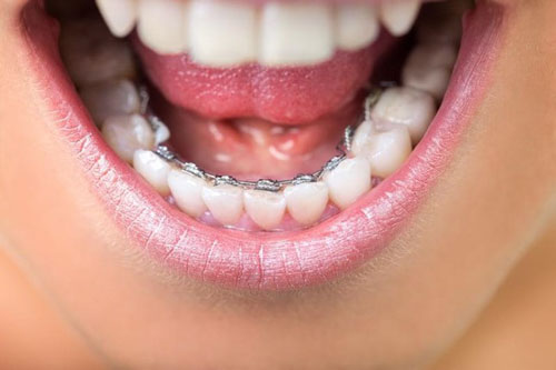 Niềng răng mặt trong với khí cụ được gắn toàn bộ ở mặt trong của răng