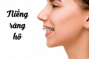 Read more about the article Quy trình niềng răng hô diễn ra như thế nào? Gồm bao nhiêu bước?