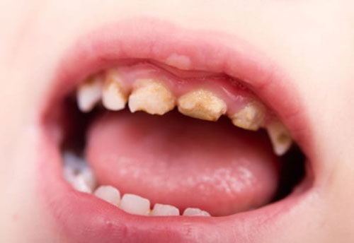 Răng thiếu sản men dễ sâu răng