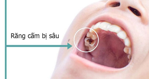 Sâu răng có nên nhổ bỏ đi không?