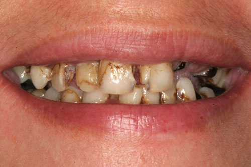 Sâu răng cửa có thể làm cho răng bị lung lay