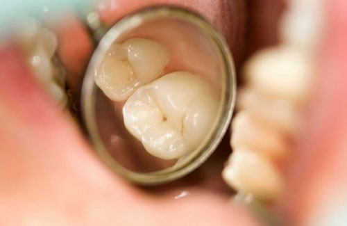 Sâu răng hàm số 7 sau khi nhổ răng khôn