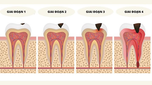 Sâu răng hình thành qua 4 giai đoạn