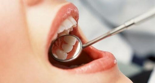 Sâu răng không phải bệnh truyền nhiễm
