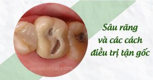 Read more about the article Sâu răng: nguyên nhân và cách điều trị tận gốc