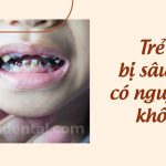 Sâu răng trẻ em: Nguyên nhân, cách điều trị và phòng ngừa hiệu quả
