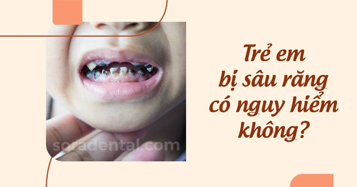 Read more about the article Sâu răng trẻ em: Nguyên nhân, cách điều trị và phòng ngừa hiệu quả