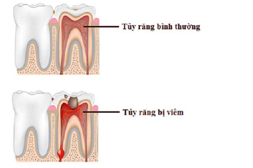 Thăm khám, điều trị tủy răng ở giai đoạn nhẹ